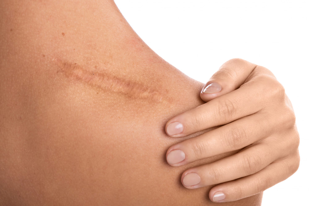 Medicina estética - valoración cicatricial: Evaluación profesional para mejorar la apariencia de las cicatrices